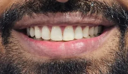 After treatment - Case 1