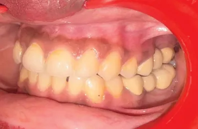 After treatment - case 4