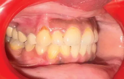 After treatment - case5
