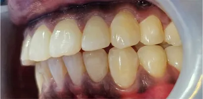 After treatment - case 8