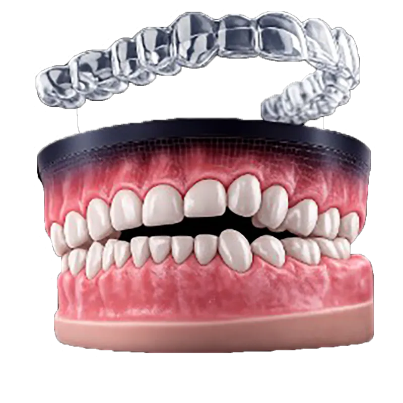 Crowded Teeth