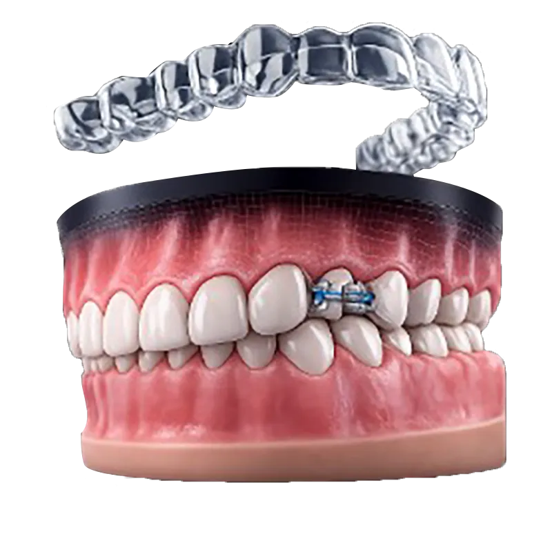 Extraction Cases